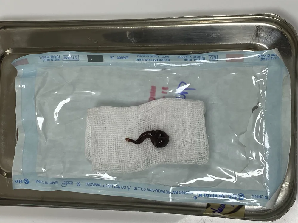 Con đỉa được gắp ra khỏi mũi bệnh nhân