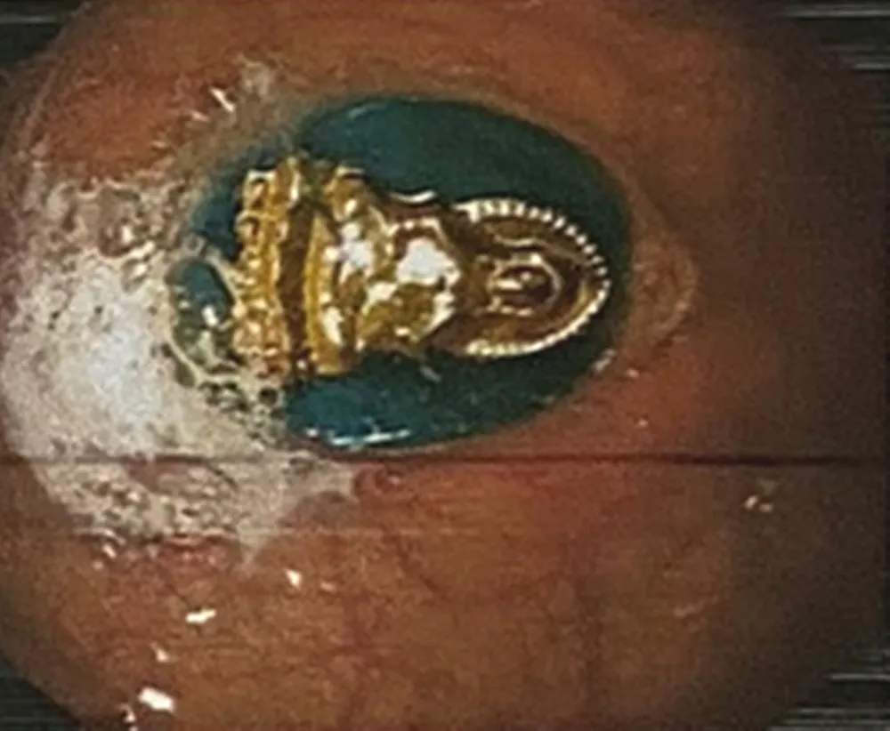 Hà Tĩnh: Gắp thành công mặt dây chuyền trong dạ dày bệnh nhân 2 tuổi ảnh 1