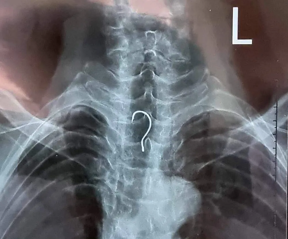 Lưỡi câu dài gần 4cm mắc trong thực quản cụ ông 83 tuổi ảnh 1