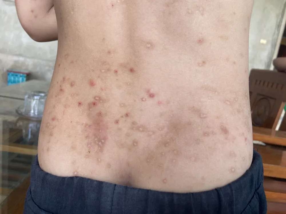 Người dân bị côn trùng đốt gây sẩn, ngứa Người dân bị côn trùng đốt gây sẩn, ngứa