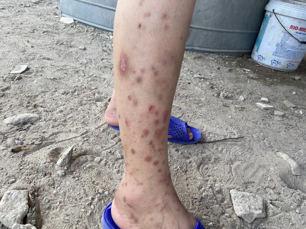 Người dân bị côn trùng đốt gây ra viêm da tiếp xúc Người dân bị côn trùng đốt gây ra viêm da tiếp xúc