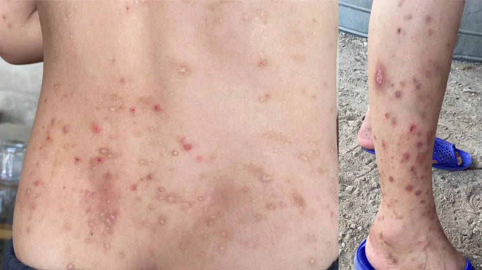 Người dân bị côn trùng đốt gây ra viêm da tiếp xúc