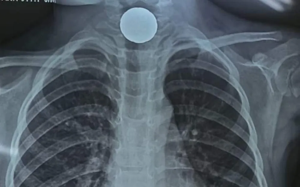 Hình ảnh đồng xu mắc tại thực quản qua phim chụp X.Quang
