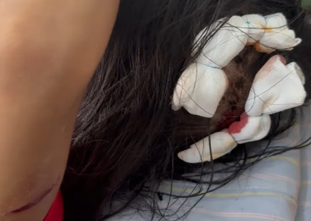 Cháu L. với vết thương trên đầu và tay