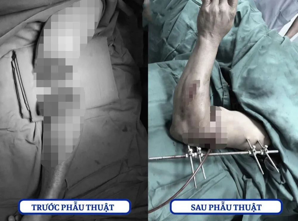 Hình ảnh trước và sau phẫu thuật. Ảnh: Bệnh viện Chấn thương Chỉnh hình Nghệ An