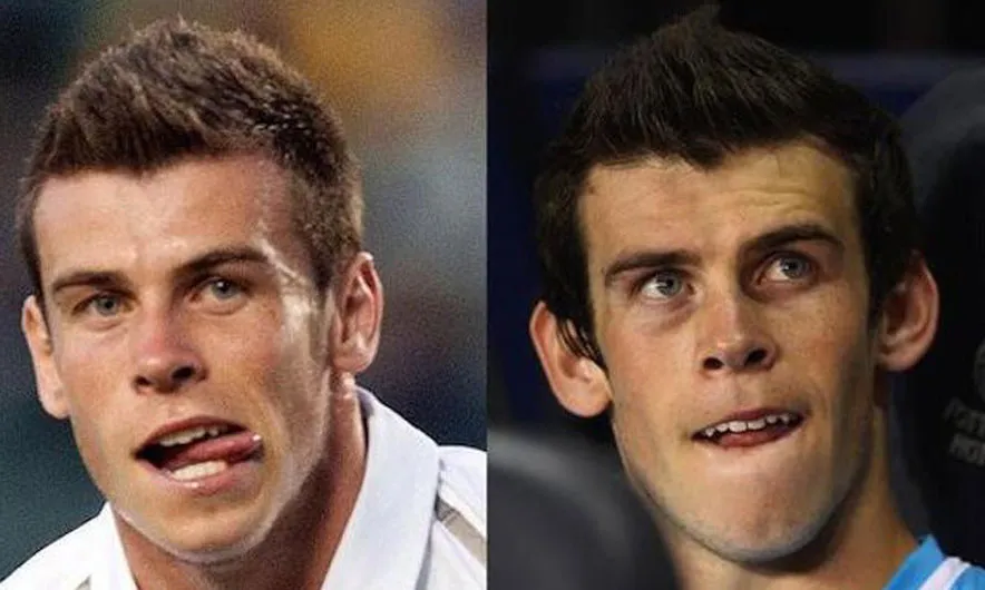 Hồ sơ Gareth Bale: Hóa rồng nhờ phẫu thuật “đôi tai khỉ” ảnh 3