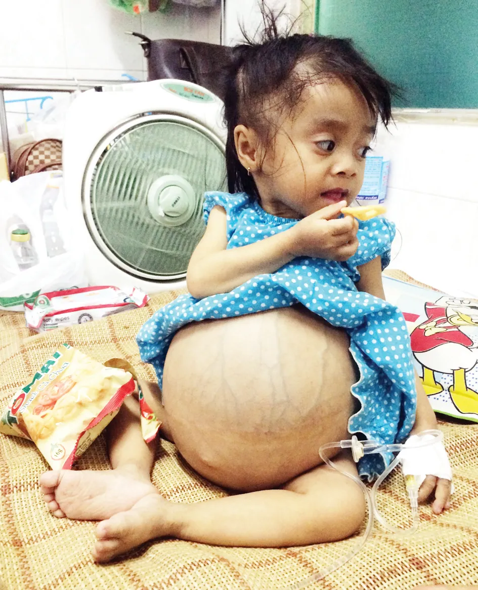 Ung thư khi mới lọt lòng mẹ ảnh 1