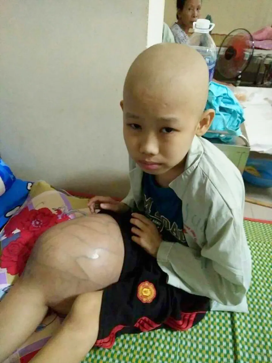 Bé bị ung thư xương, chân sưng to  ảnh 1