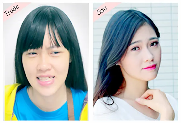 Hỗ trợ 70% chi phí phẫu thuật hàm mặt