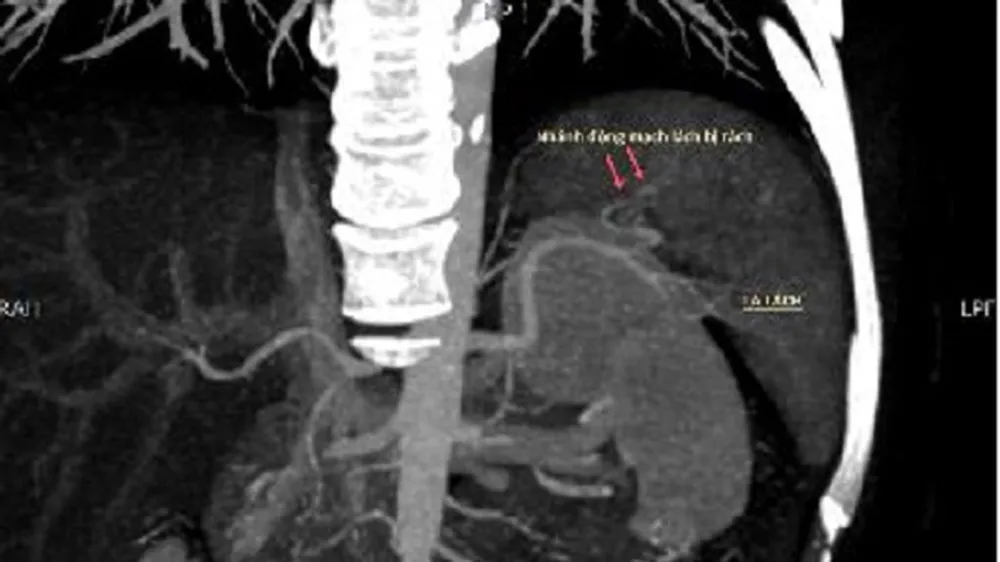 Cứu sống bệnh nhân chấn thương vỡ lách do tai nạn xe máy ảnh 1