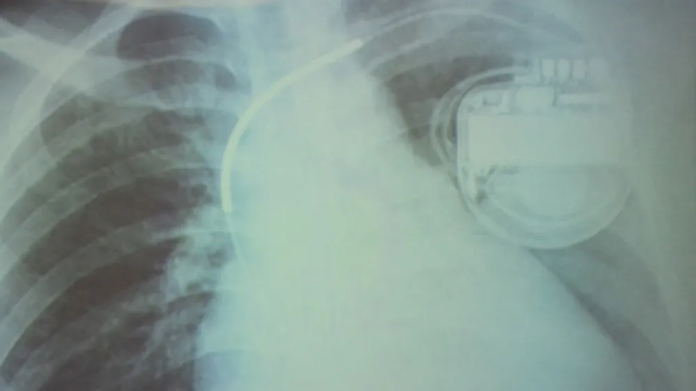 Cứu sống bệnh nhân bị loạn nhịp tim hiếm gặp ảnh 1