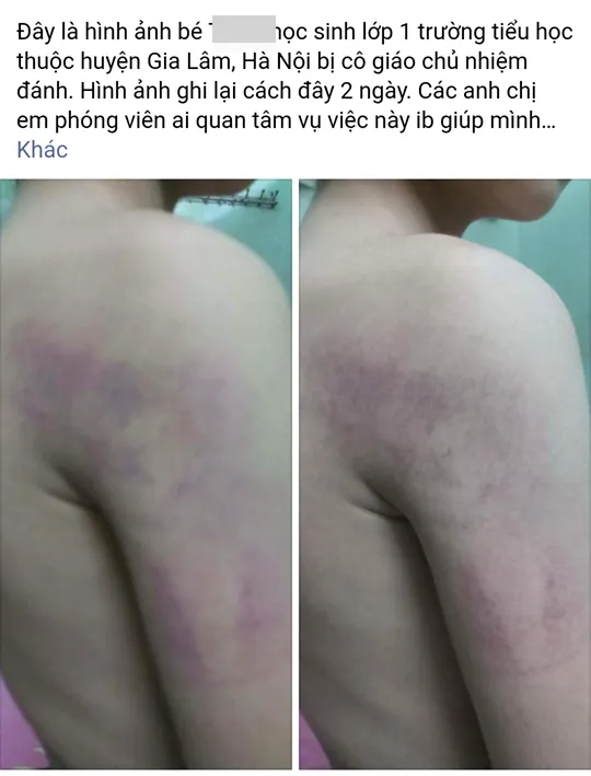 Cô giáo tại Hà Nội đánh học sinh lớp 1 bầm tím cánh tay ảnh 2