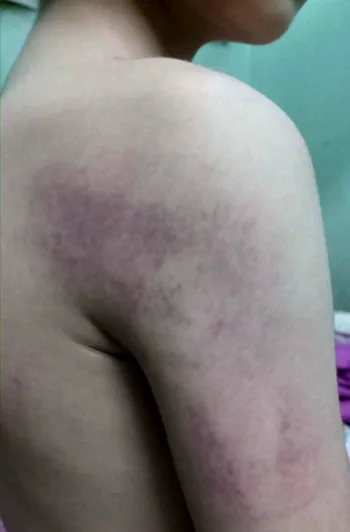 Cô giáo tại Hà Nội đánh học sinh lớp 1 bầm tím cánh tay ảnh 1