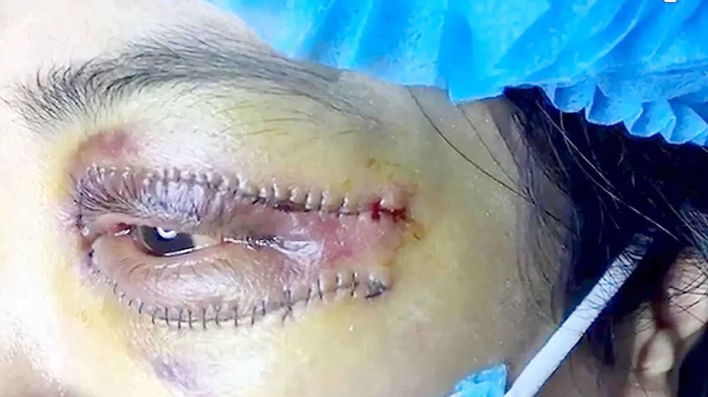 Spa vẫn tiêm filler, cắt mí mắt ảnh 2