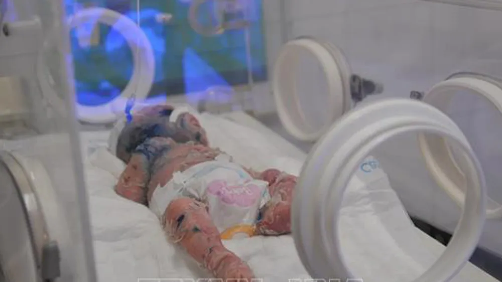 Bệnh nhi N.H.H đang được tích cực điều trị tại Bệnh viện Nhi đồng Đồng Nai