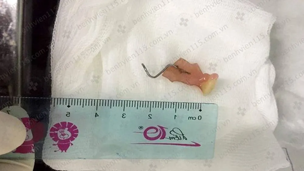 Chiếc răng giả sau khi được lấy ra. Ảnh: BV CUNG CẤP