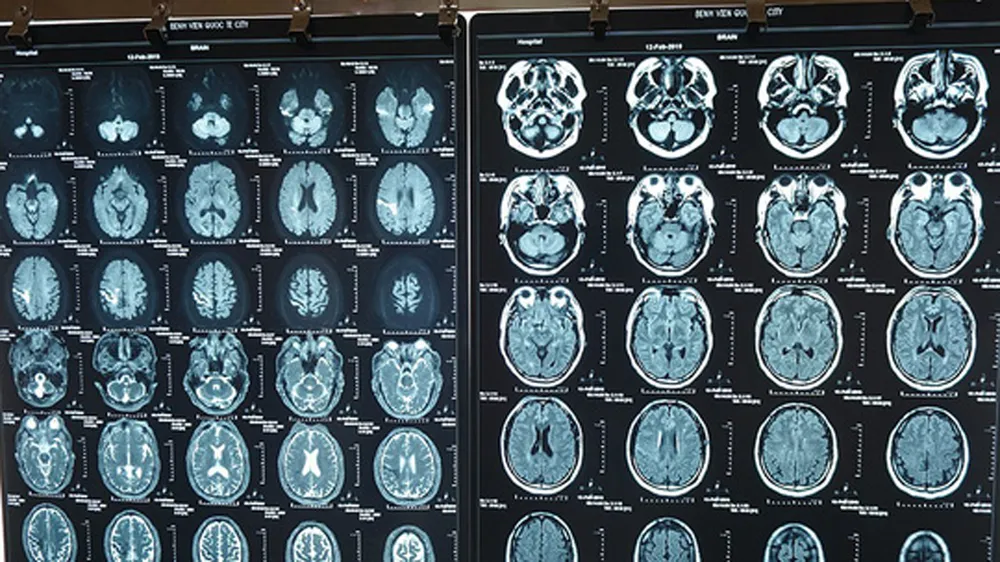 Hình ảnh chẩn đoán nhồi máu não của người đàn ông nước ngoài