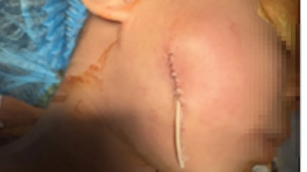 Dị vật đã được lấy ra khỏi vùng má