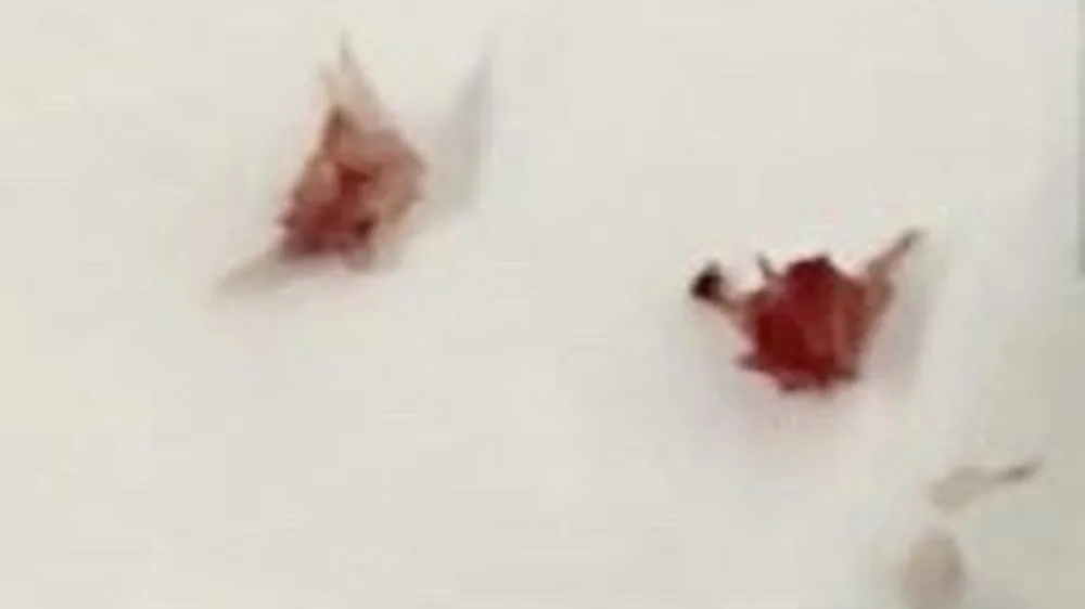 Các mảnh xương lươn được nội soi gắp ra ngoài thành công. Ảnh: BVCC