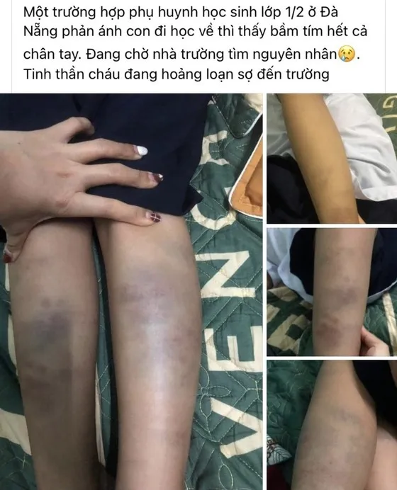 Mạng xã hội đăng tải thông tin một cháu bé bị bầm tím 2 chân