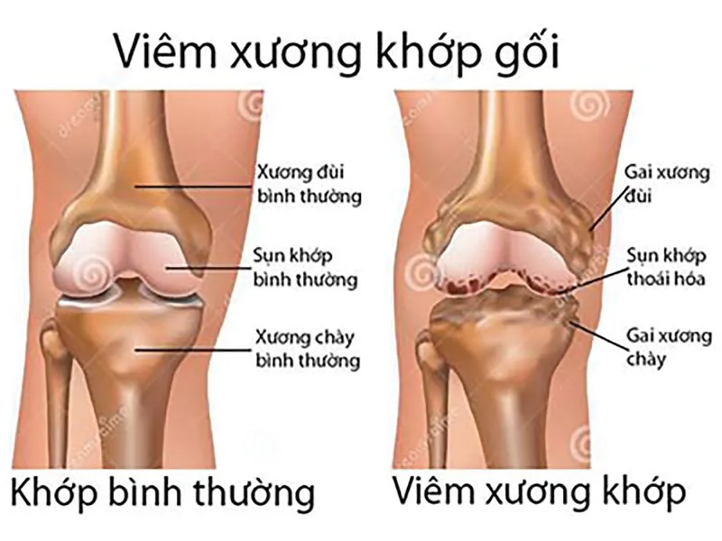 Từ biệt đau đớn do bệnh xương khớp ảnh 1