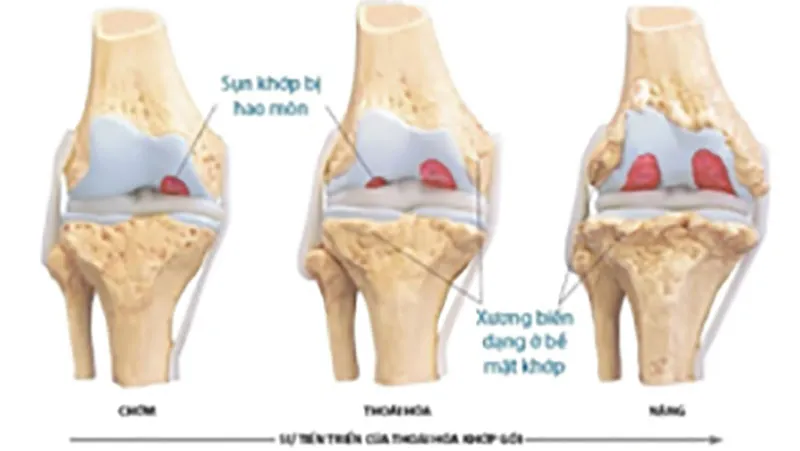 Cứ 4 người mắc thoái hóa khớp thì có 1 người bị tàn phế ảnh 1