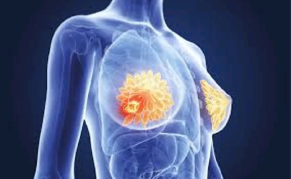 Thiết bị ADN mở ra hướng điều trị nhiều loại bệnh ung thư, trong đó có ung thư vú