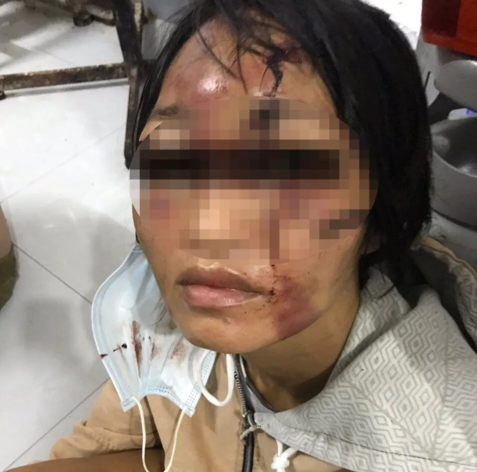 Nạn nhân H. với những vết thương bầm tím vùng đầu, mặt. Ảnh: CACC