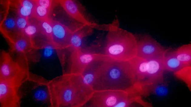 Thuốc mới chống ung thư vú