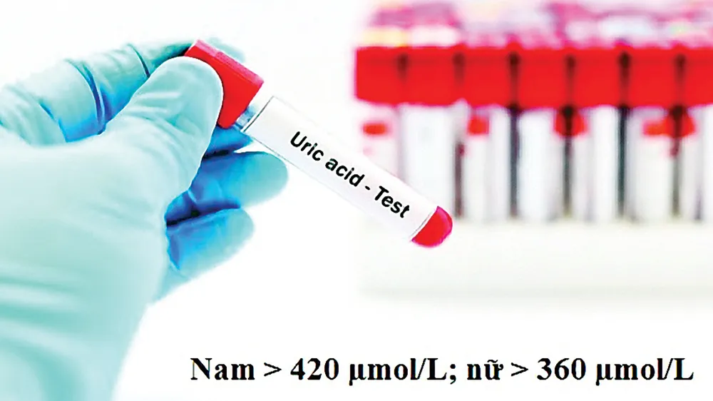 Chỉ số acid uric cao, sưng, đau do Gút làm thế nào để bớt tái phát?