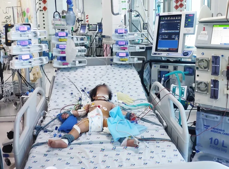Bé gái trụy tim, nguy kịch do mắc tay chân miệng. Ảnh: Bệnh viện cung cấp