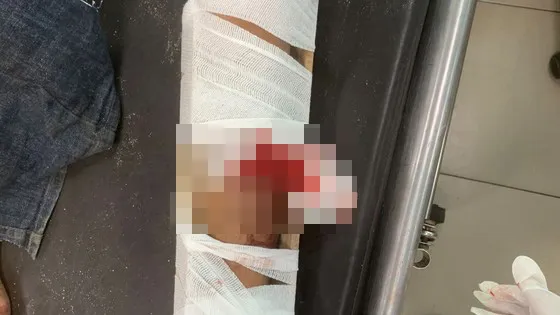 Bệnh nhân tên N.V.C.( 27 tuổi, ngụ huyện Vĩnh Cửu) bị gãy chân, nồng độ cồn trong máu rất cao