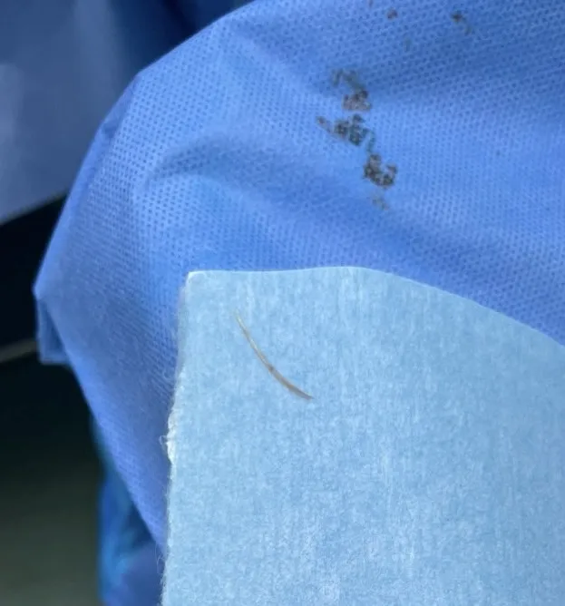 Mảnh xương cá dài 3,5cm đâm xuyên ruột, chui vào ổ bụng bệnh nhân Mảnh xương cá dài 3,5cm đâm xuyên ruột, chui vào ổ bụng bệnh nhân