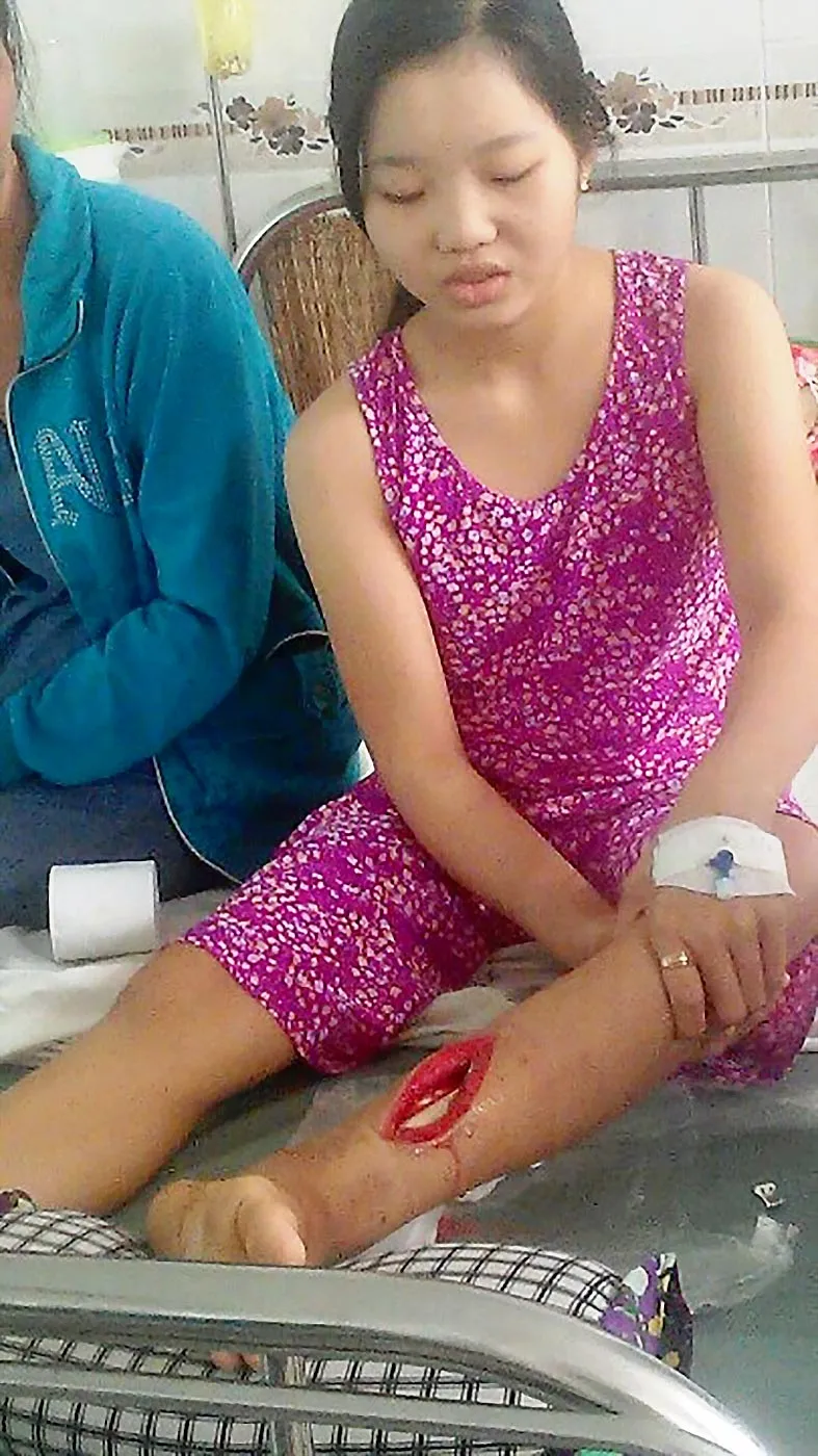 Cháu Nhã với vết thương bị nhiễm trùng rất nặng nhưng không tiền điều trị