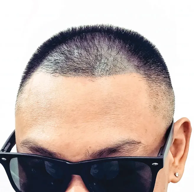 Chống hói đầu bằng nghệ thuật xăm ảnh 2