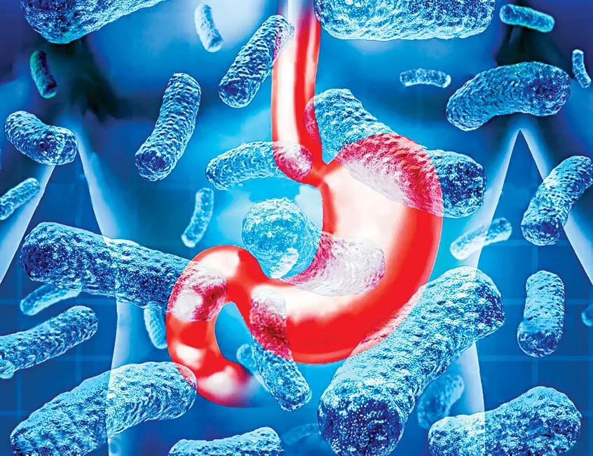 Đừng chủ quan ung thư dạ dày ảnh 2