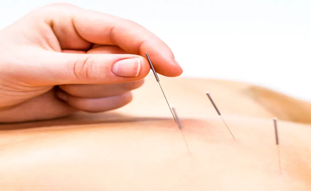 Điều trị rối loạn giấc ngủ bằng châm cứu ảnh 2