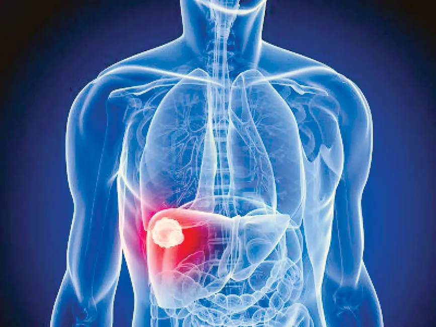 Tầm soát sớm ung thư biểu mô tế bào gan ảnh 2