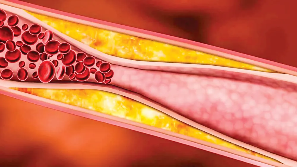 Những nguy cơ gây bệnh động mạch vành ảnh 2