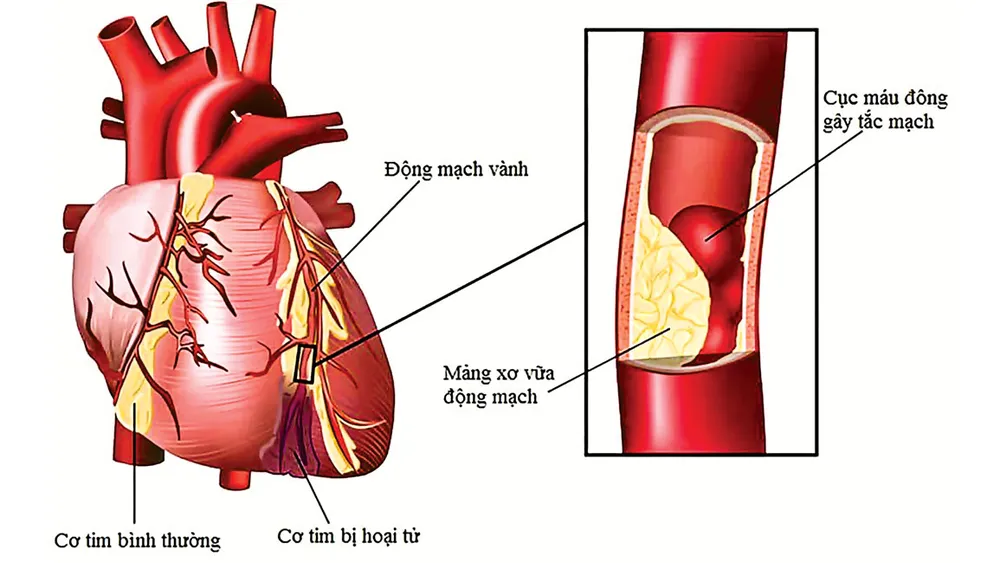 Những biểu hiện bệnh động mạch vành ảnh 2