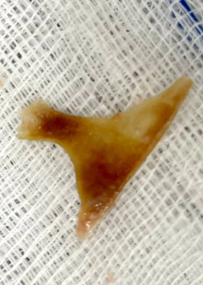 Nội soi thành công lấy xương heo 3 cạnh ở thực quản ảnh 1