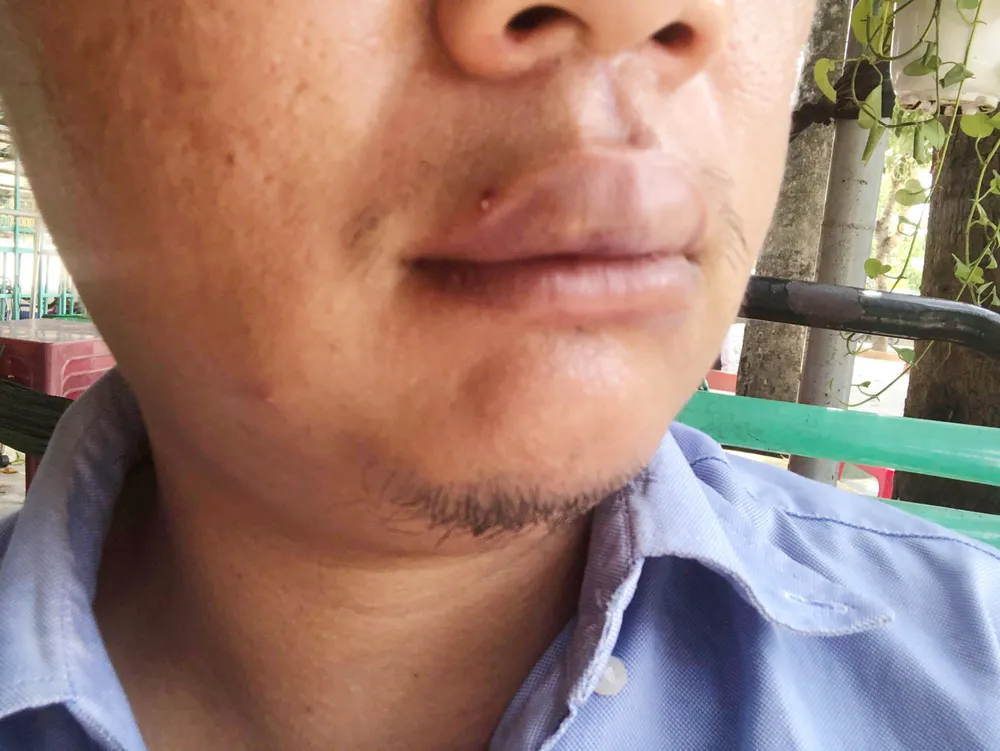  Phóng viên VOV bị hành hung, thương ở vùng mặt, kể lại sự việc.