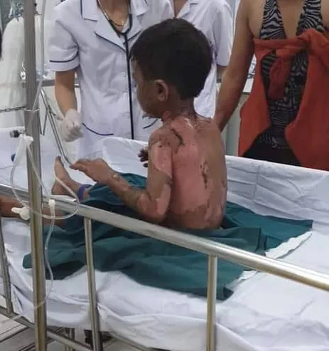 Khởi tố vụ án cháu bé bị dì ruột châm xăng đốt bỏng nặng hơn 50% ảnh 2