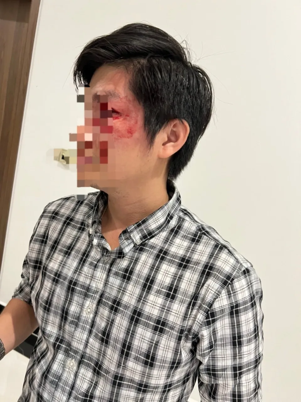 Nạn nhân với thương tích trên mặt Nạn nhân với thương tích trên mặt