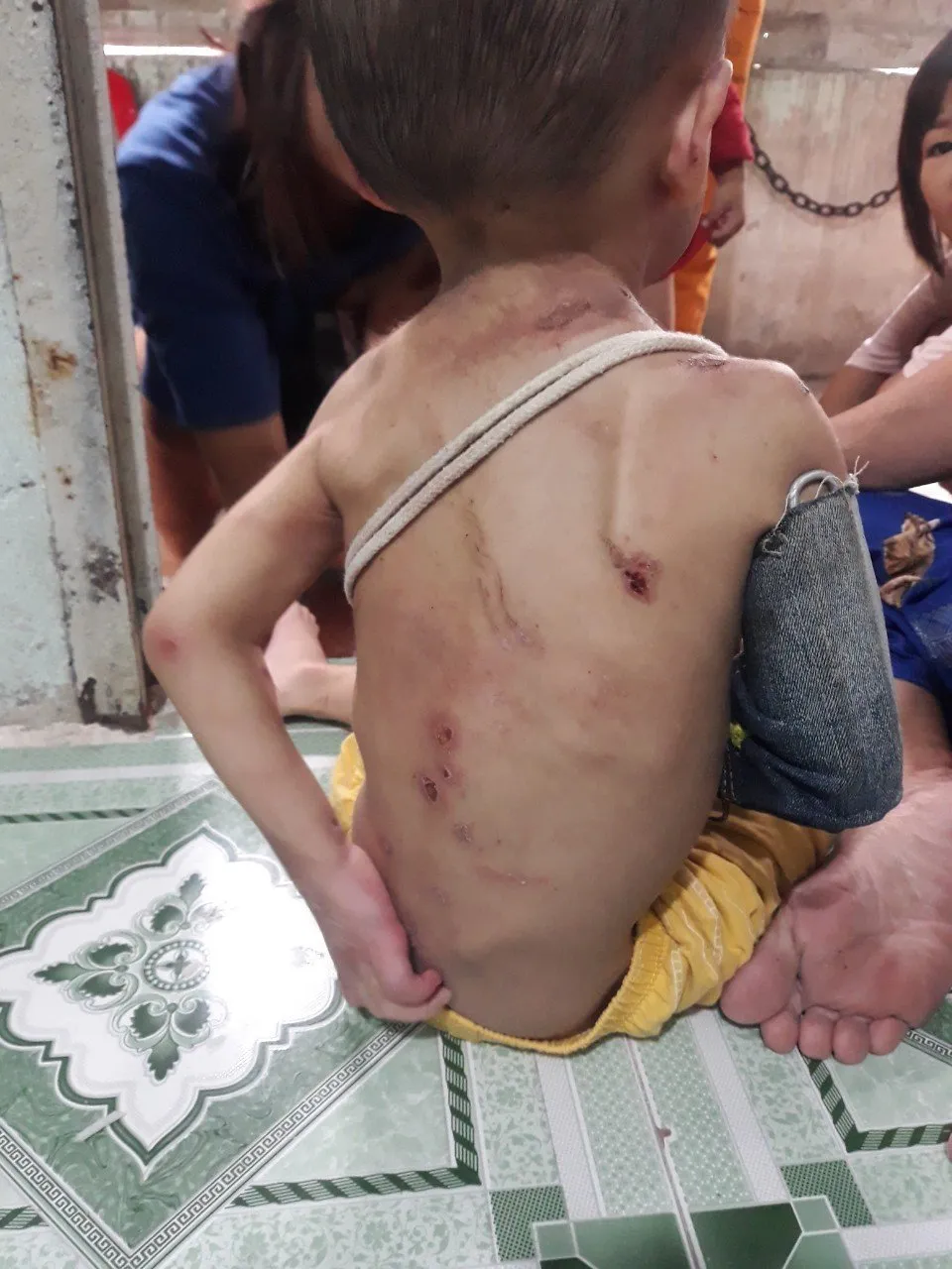 Thương tích trên người bé trai