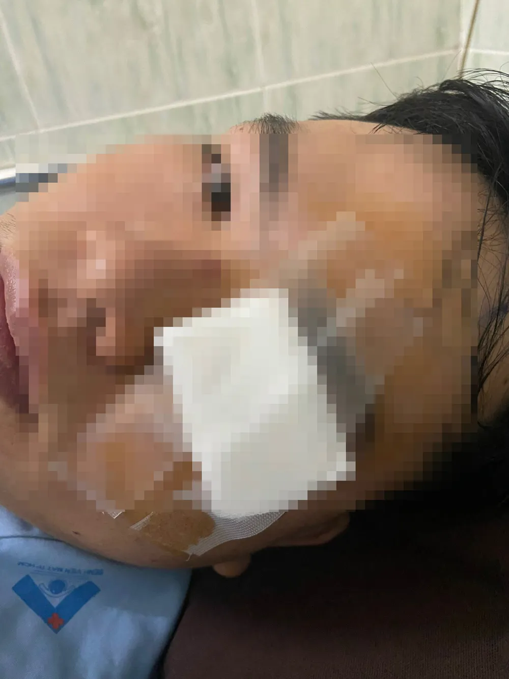 Anh N. với thương tích trên mắt