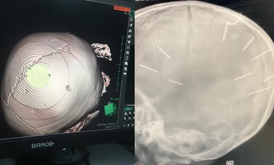 Hình ảnh chụp hộp sọ bé A do bị đối tượng Huyên dùng đinh đóng vào đầu