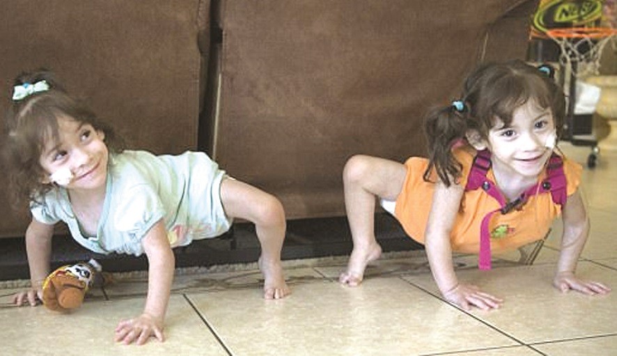 美連體女嬰分離手術後健康成長。（圖片來源：互聯網）