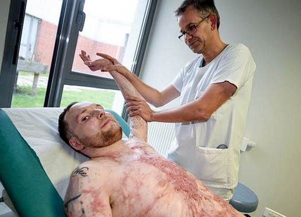 法為燒傷 95% 患者異體植皮手術。