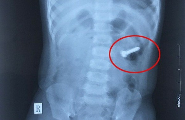 兩歲女孩誤吞３釐米螺絲釘